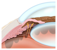 Glaucoma Treatment Chester | Morristown | Bridgewater | Morris County