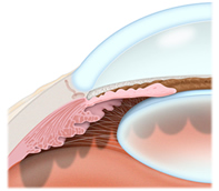 Glaucoma Treatment Chester | Morristown | Bridgewater | Morris County