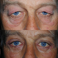 Blepharoplasty | Eyelid Surgery | Chester NJ | Morristown | Bridgewater