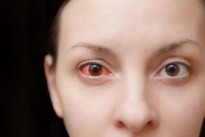 Pink Eye Information Chester | Conjunctivitis Treatment Parsippany-Troy Hills